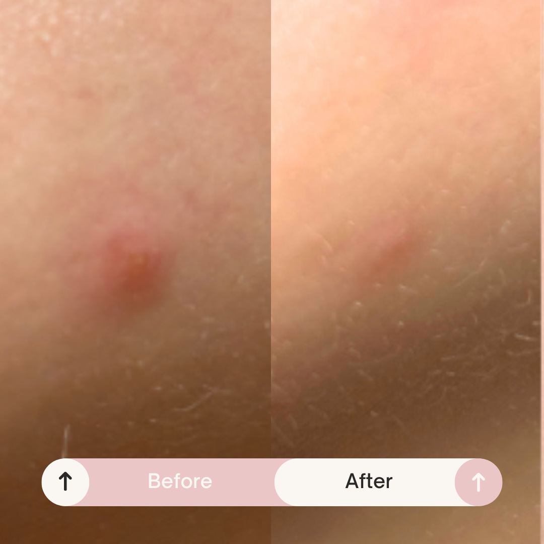 Maskeraide - Spotted Daytime - Invisible Hydrocolloid Patches