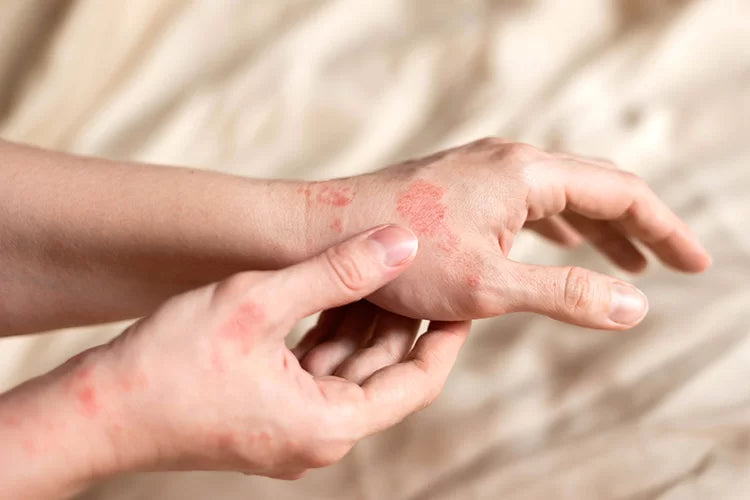 Eczema consultation - Free for Ontario residents with Ontario a valid Ontario health card
